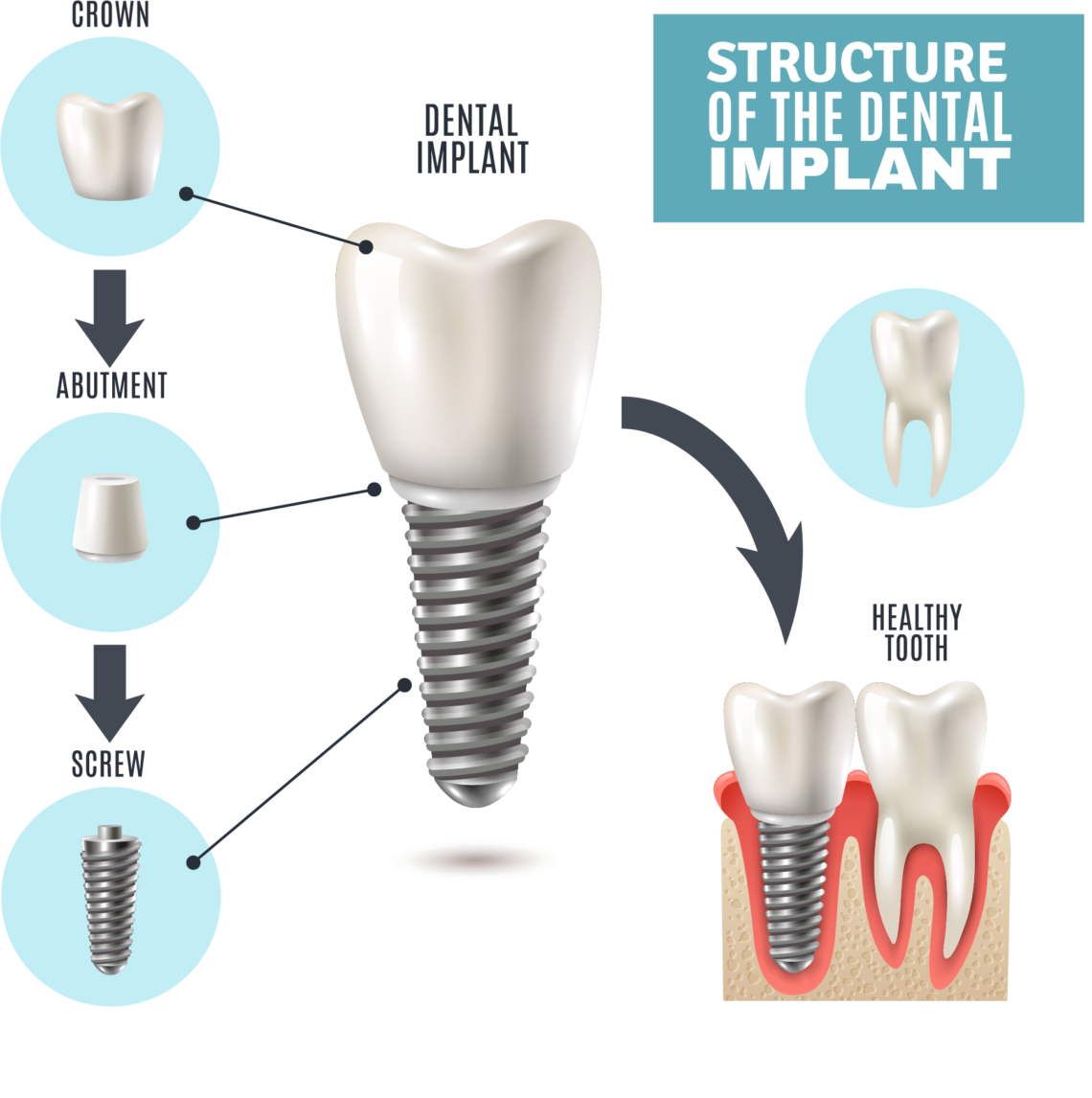 What is a Dental Implant? DDI (Dorset)