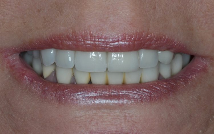 natural-looking porcelain crowns
