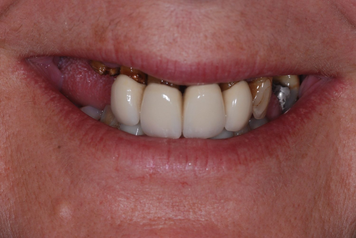 complex dental implant case