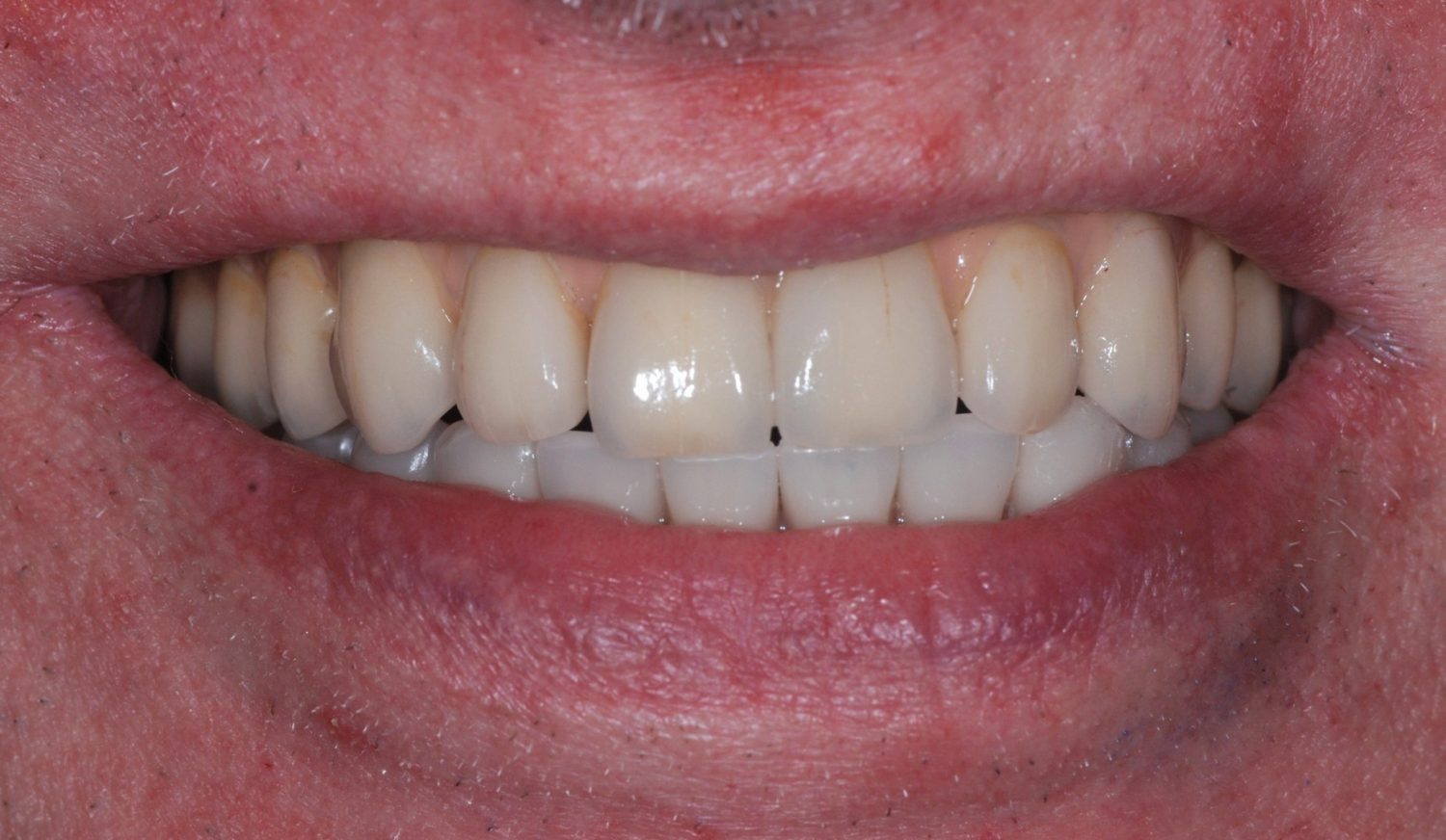 Full Mouth Implant Case After