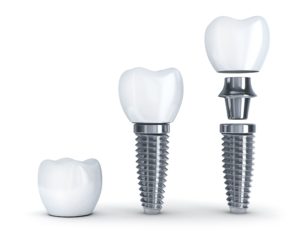 Dental implant questions and answers