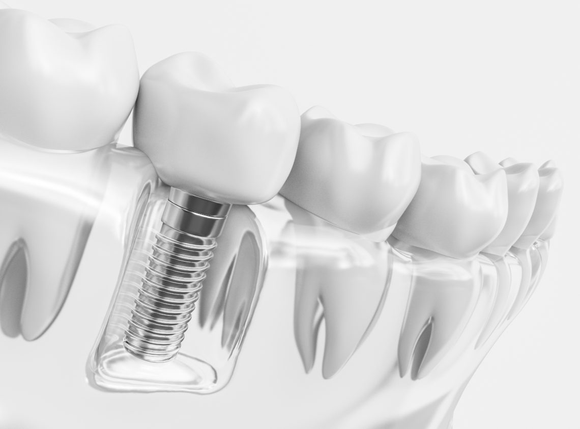 Sinus Lifts and Dental Implants | DDi