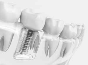 Tooth human implant. Dental concept. Human teeth or dentures. 3d rendering