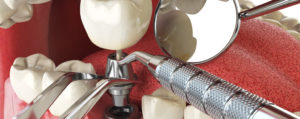 When one or more teeth are lost to trauma, gum disease or decay, delayed implants are the common restorative treatment to replace these missing teeth.