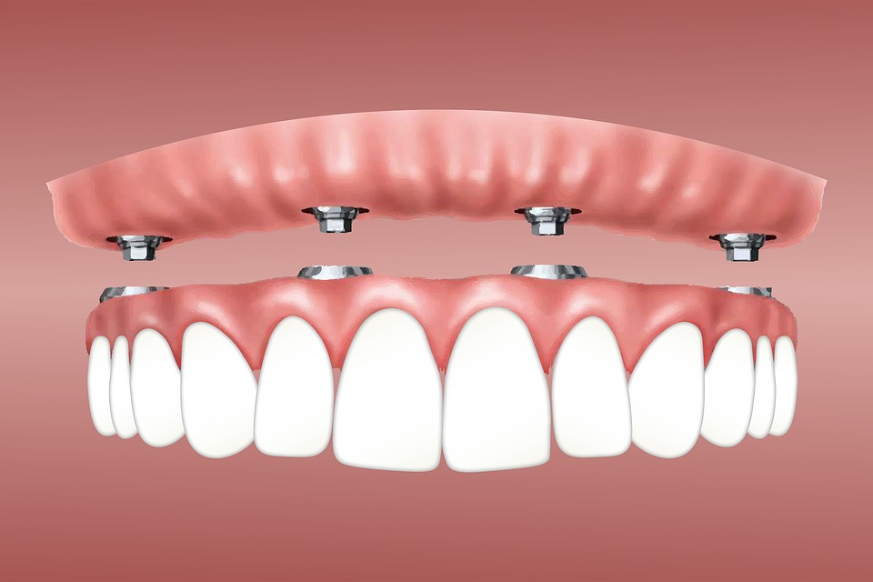 snap on dentures