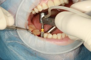 dental implants being inserted