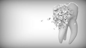 multiple missing teeth solutions in Christchurch