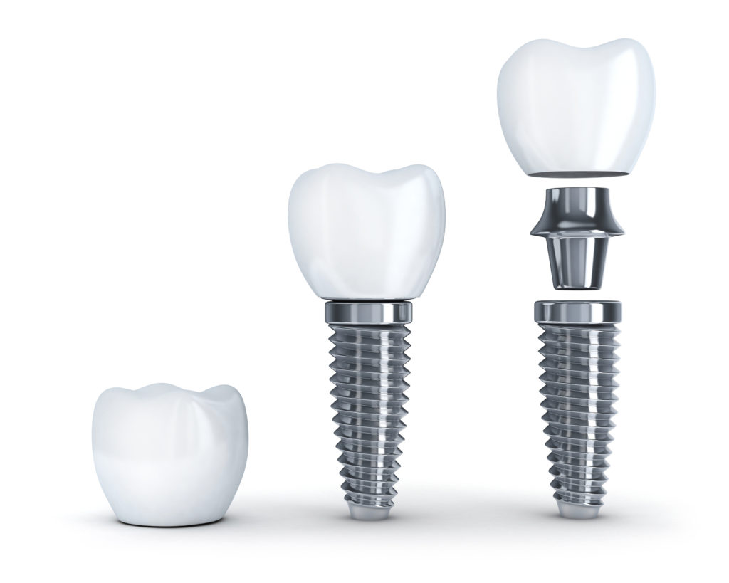 dental implants