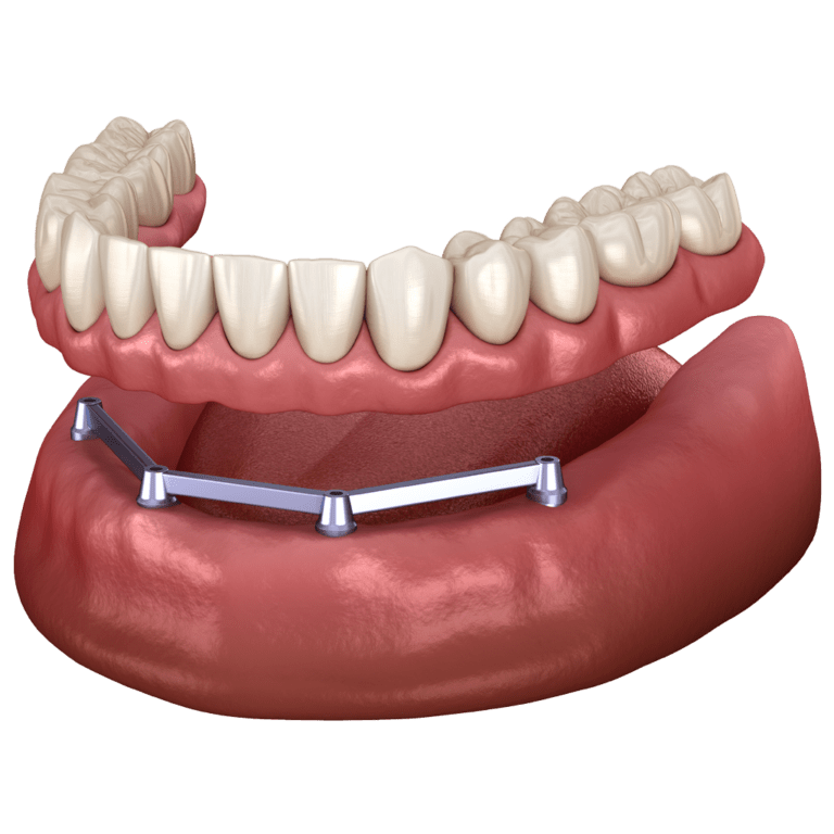 Implant Supported Denture imagary