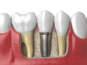 Anatomy of healthy teeth and tooth dental implant in human dentura.