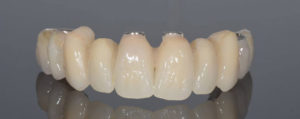 Photo of a dental implants full arch