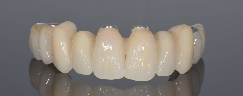 Single & Full-Arch Dental Implants