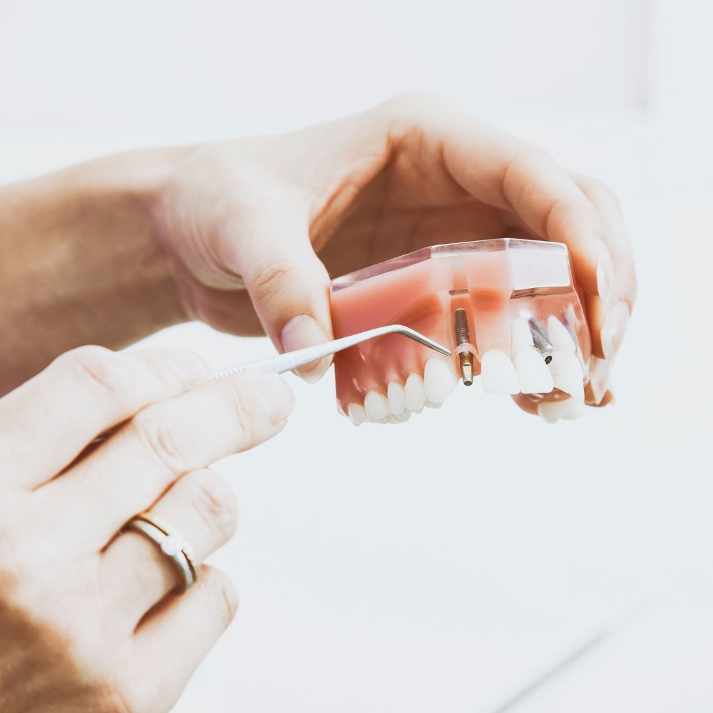 dental implant photo