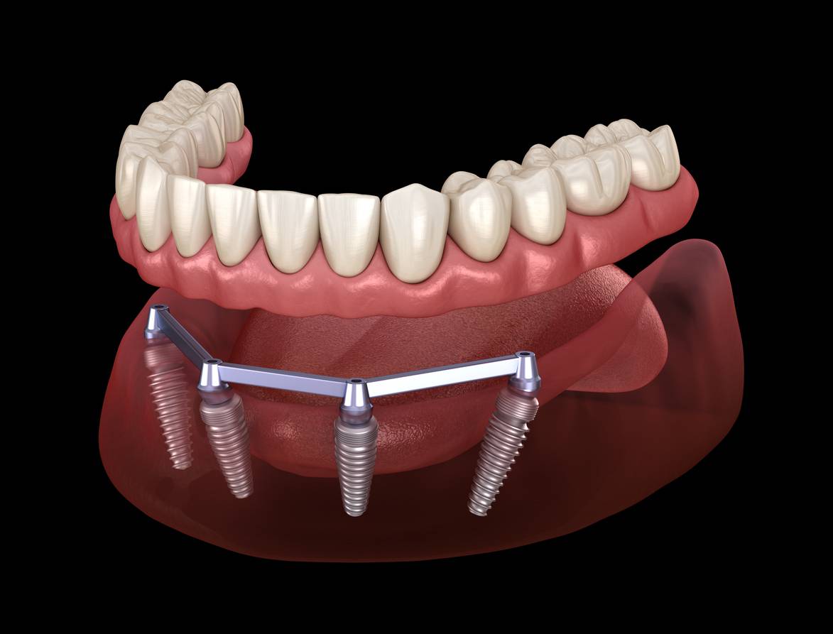 implant bar dentures
