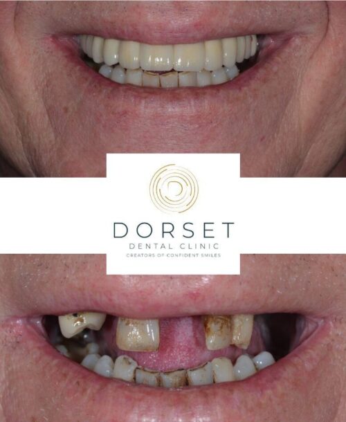 dental implant before and after