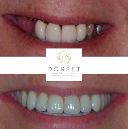 missing teeth treatment before and after