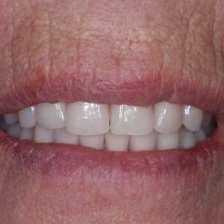 dental implants that took years off my face