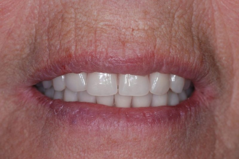 dental implants that took years off my face