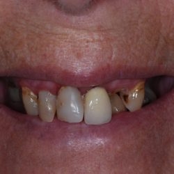 narrow smile with missing teeth