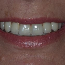 before and after images of dental implants