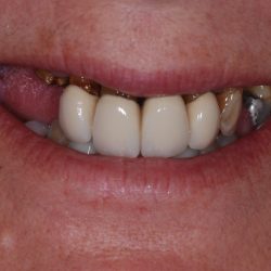 complex dental implant case