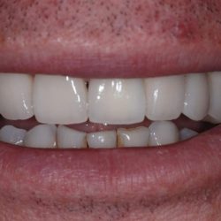 affordable dental impamts