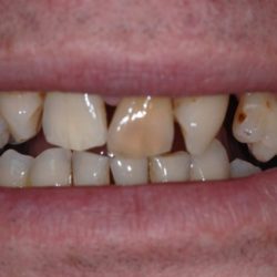 Patient experiencing gum disease