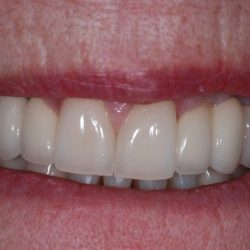 patient unhappy with dentures