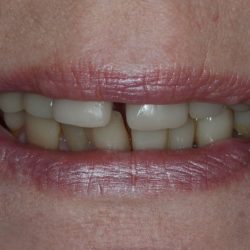 close gaps between teeth